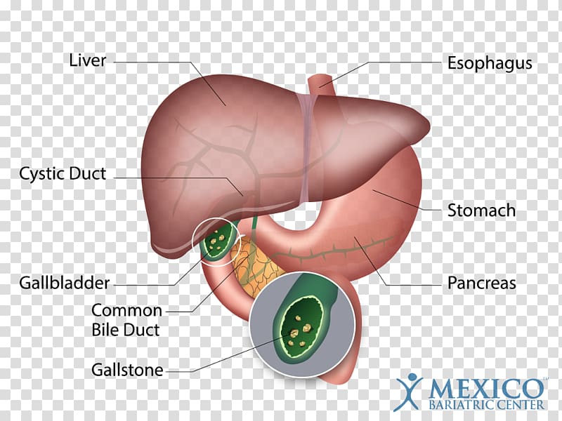 Gallstone Gallbladder disease Human anatomy, swot for hotel transparent background PNG clipart