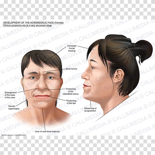 Acromegaly Face Gigantism Symptom Nose, Face transparent background PNG clipart