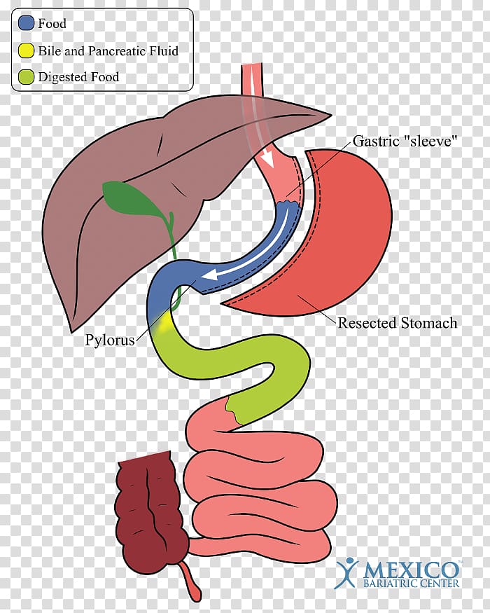 Duodenal switch Sleeve gastrectomy Bariatric surgery Gastric bypass surgery, duodenal switch vs gastric bypass transparent background PNG clipart