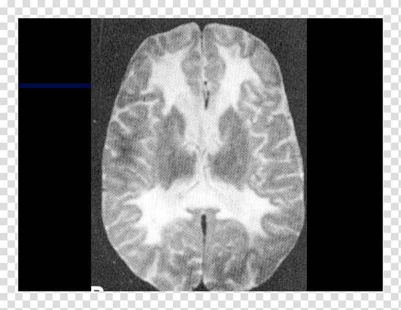 Computed tomography Lääketieteellinen röntgenkuvaus X-ray Brain Radiography, Brain transparent background PNG clipart