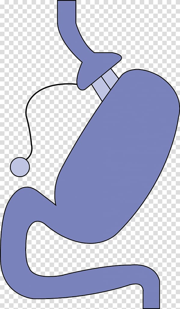 Adjustable gastric band Bariatric surgery Gastric bypass surgery Laparoscopy, others transparent background PNG clipart