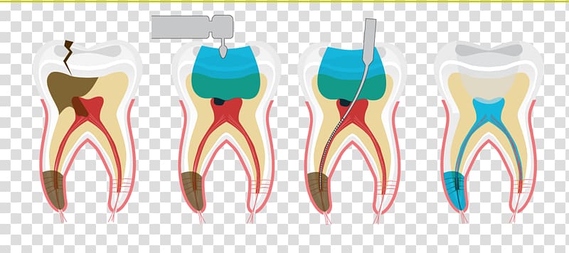 Endodontic therapy Dentistry Rehabilitación oral Pulp, dandelions transparent background PNG clipart