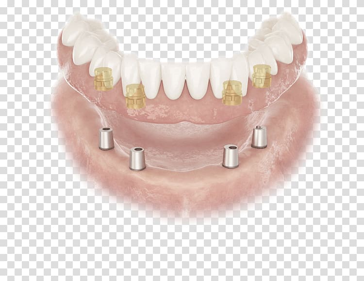 Abutment Dentures Dental implant Dentist Edentulism, others transparent background PNG clipart