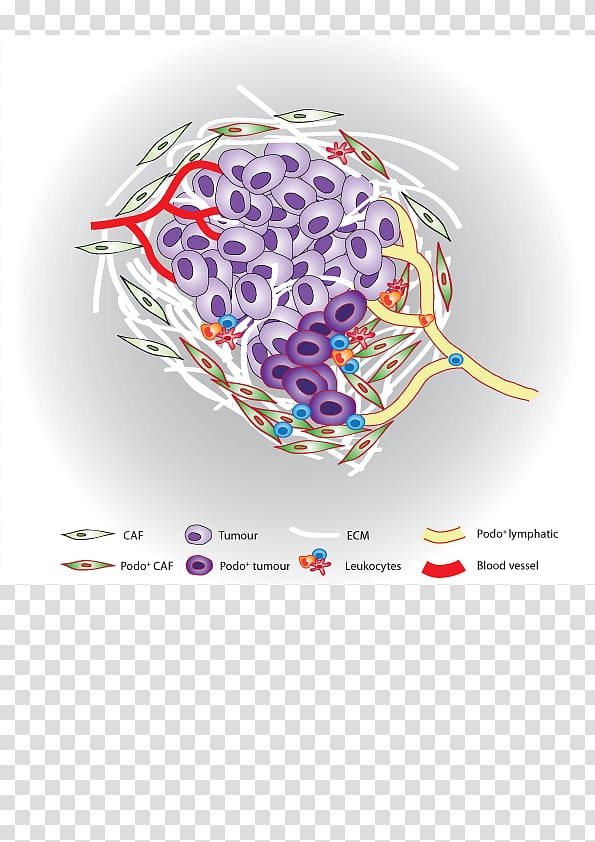 Stromal cell Cancer Tumor microenvironment, cancer cell of globular pathogen transparent background PNG clipart