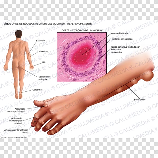 Rheumatoid arthritis Rheumatoid nodule Rheumatism, japones transparent background PNG clipart