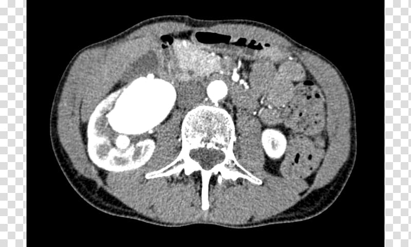 Computed tomography Medical radiography Bone Font, Renal Vein transparent background PNG clipart