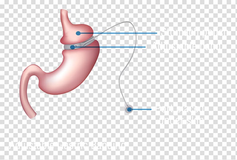 Bariatric surgery Adjustable gastric band Gastric bypass surgery Sleeve gastrectomy, gastric transparent background PNG clipart