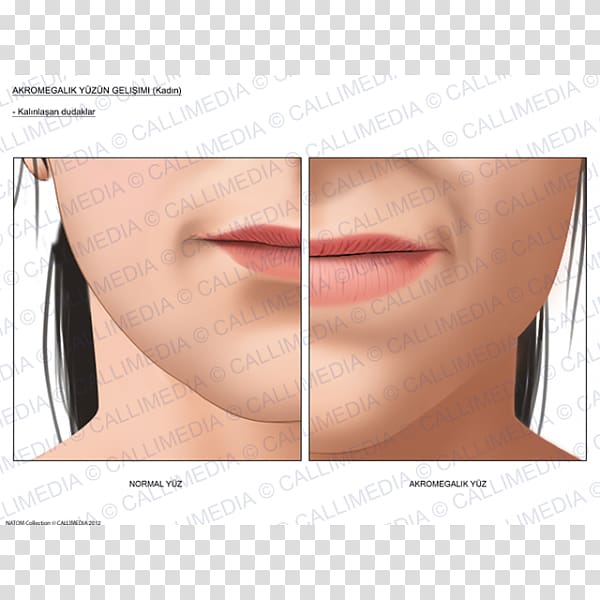 Acromegaly Lip Nose Face Diabetes mellitus, nose transparent background PNG clipart