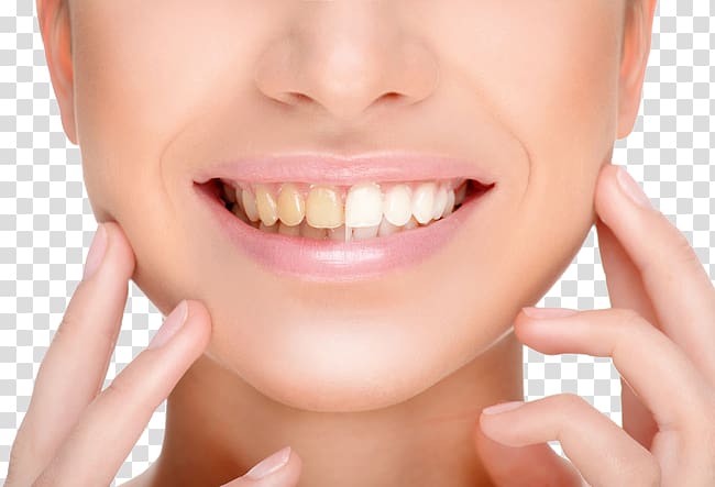 woman smiling while touching chin, Tooth whitening Human tooth Cosmetic dentistry, Teeth whitening transparent background PNG clipart