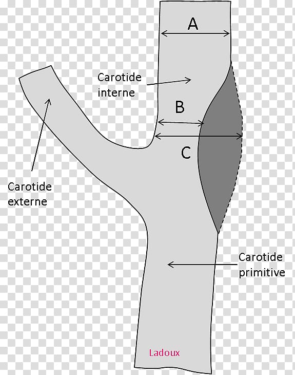 Carotid artery stenosis Common carotid artery Internal carotid artery Doppler ultrasonography, occlusion transparent background PNG clipart