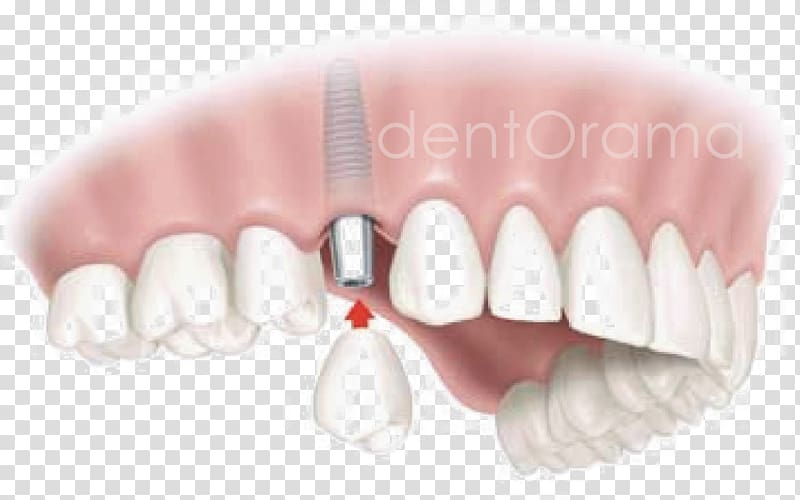 Dental implant Dentistry Edentulism Tooth, bridge transparent background PNG clipart