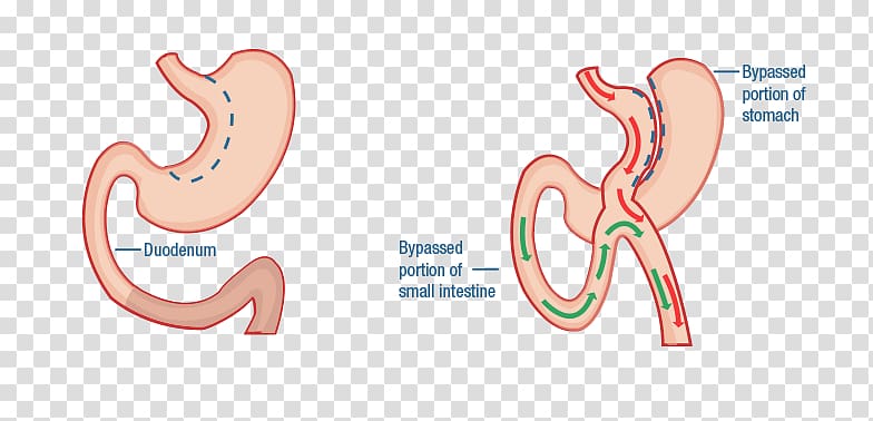 Duodenal switch Bariatric surgery Duodenum Gastric bypass surgery, Diabetes Mellitus Type 2 transparent background PNG clipart