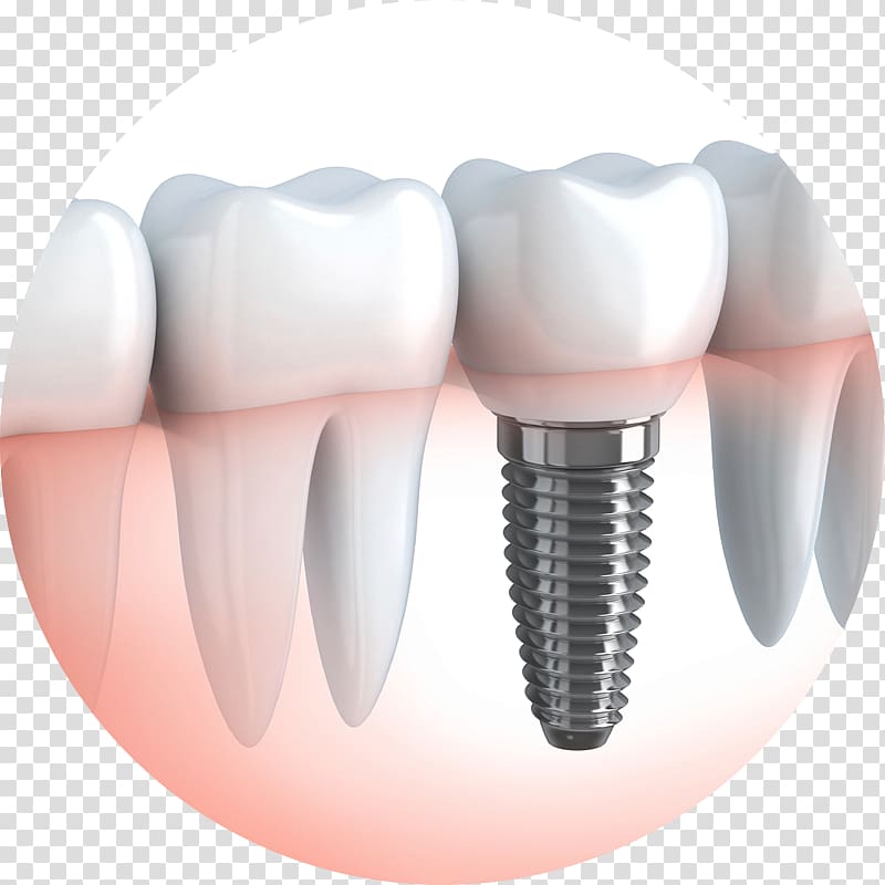 Dental implant Dentistry Chapel Gate Dental Crown, crown transparent background PNG clipart