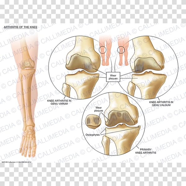 Thumb Human leg Hip Knee Shoulder, artrosis de rodilla transparent background PNG clipart