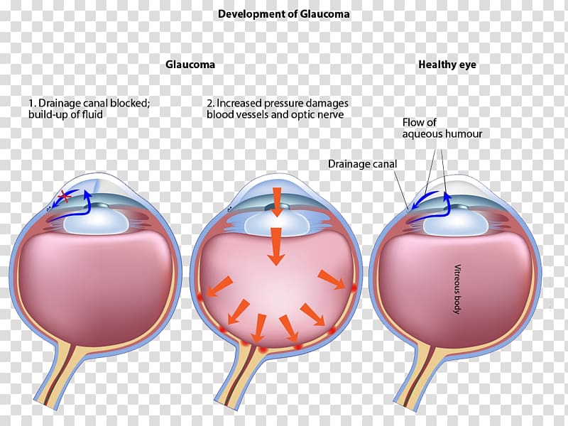 Glaucoma Laser surgery Eye Disease Ophthalmology, aqueous transparent background PNG clipart