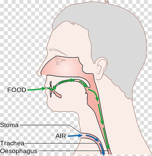 Laryngectomy Voice prosthesis Larynx Nose, nose transparent background PNG clipart