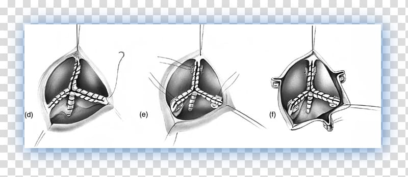 Aortic valve Left coronary artery Coronary arteries Aorta, Percutaneous Aortic Valve Replacement transparent background PNG clipart