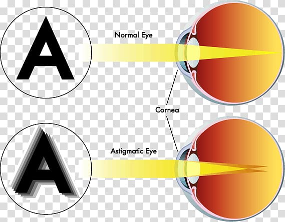 Astigmatism Near-sightedness Eye Far-sightedness Visual perception, Astigmatism Headaches transparent background PNG clipart