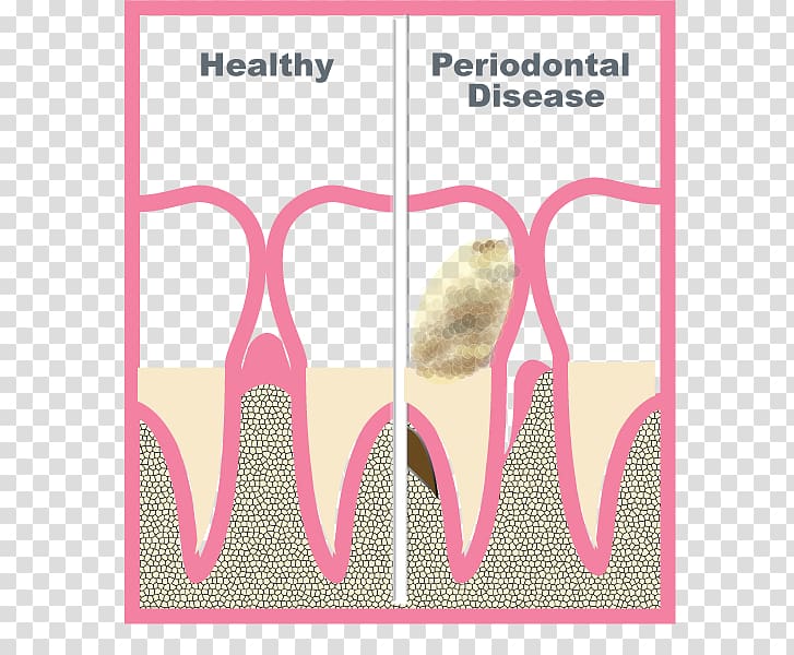 Periodontology Periodontal disease Periodontium Gums Tooth, others transparent background PNG clipart