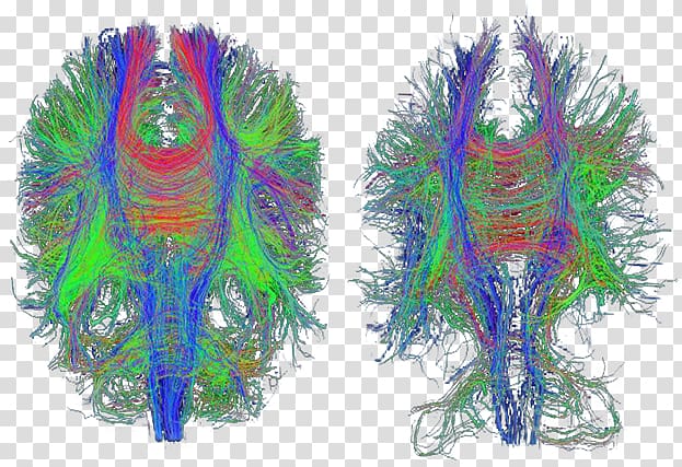 Traumatic brain injury Diffusion MRI Alzheimer\'s disease Medical imaging, Brain transparent background PNG clipart