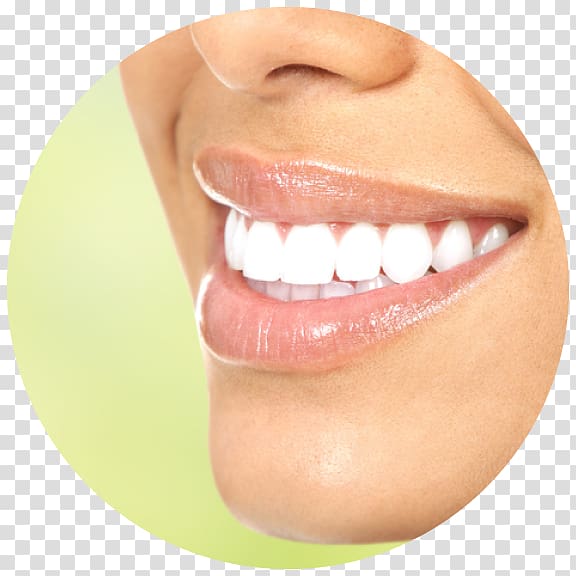 Tooth whitening Cosmetic dentistry, veneers transparent background PNG clipart
