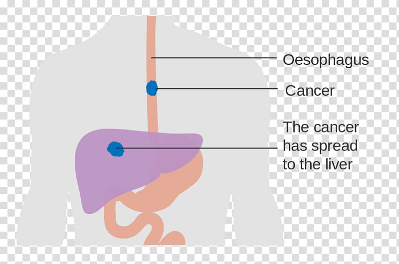 Esophageal cancer Esophagus Dysphagia Disease, basal transparent background PNG clipart