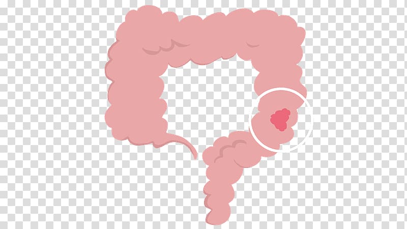 Colorectal cancer Large intestine Surgery Treatment of cancer, sense of prevention transparent background PNG clipart