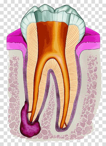 Endodontic therapy Root canal Endodontics Dentistry, crown transparent background PNG clipart